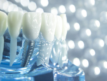 Dental Implants Melbourne