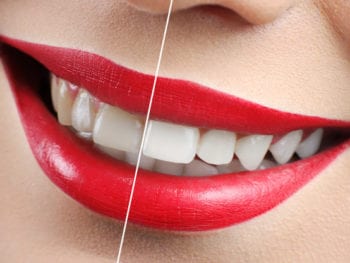 Laser Teeth whitening