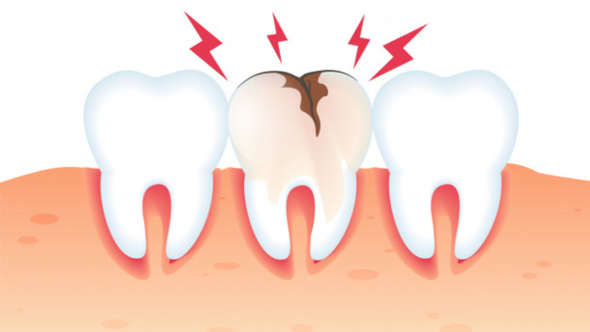 The lowdown on teeth filling | Dentist Werribee