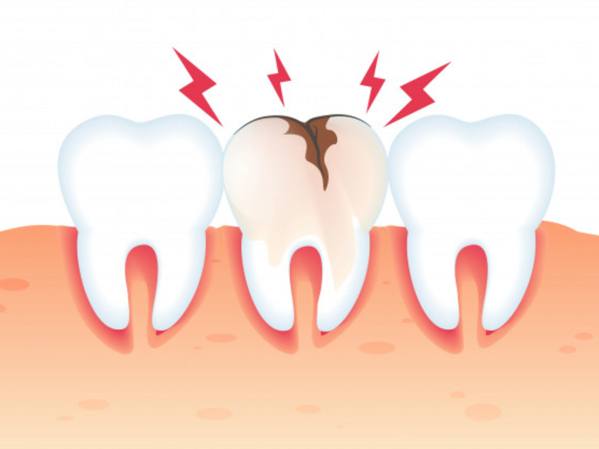 Wisdom Tooth Filling