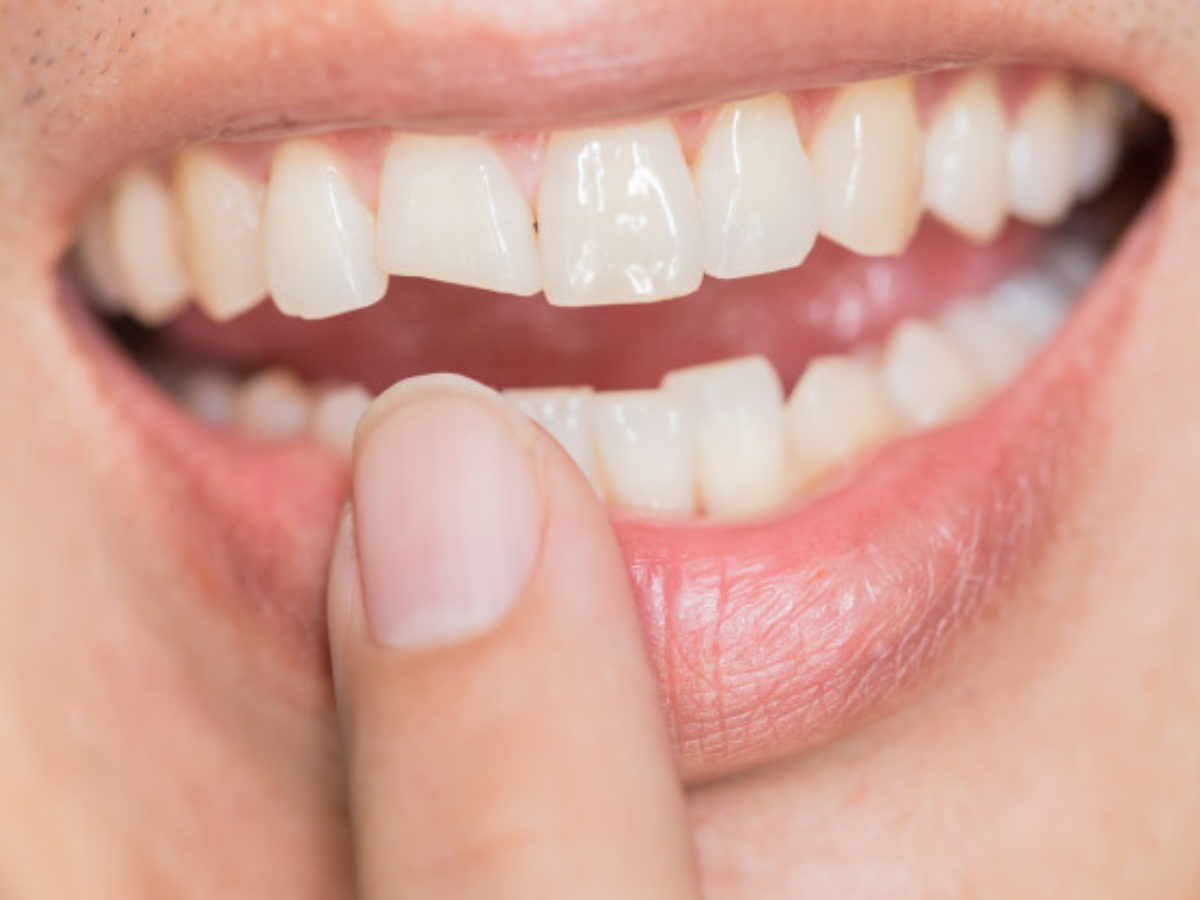 invisalign aspendale