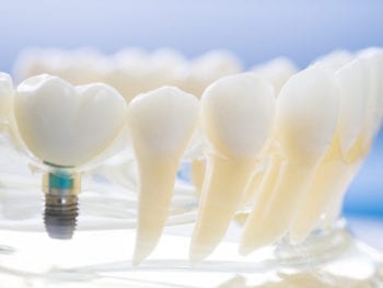Dental Implants procedure