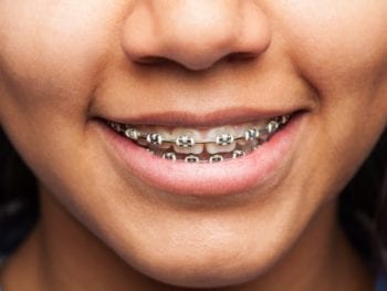 orthodontics treatment