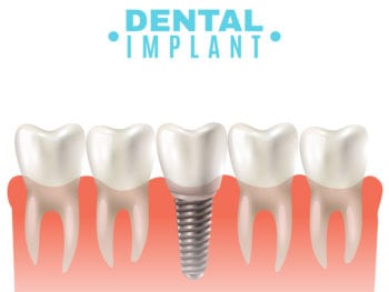 Dental Implant